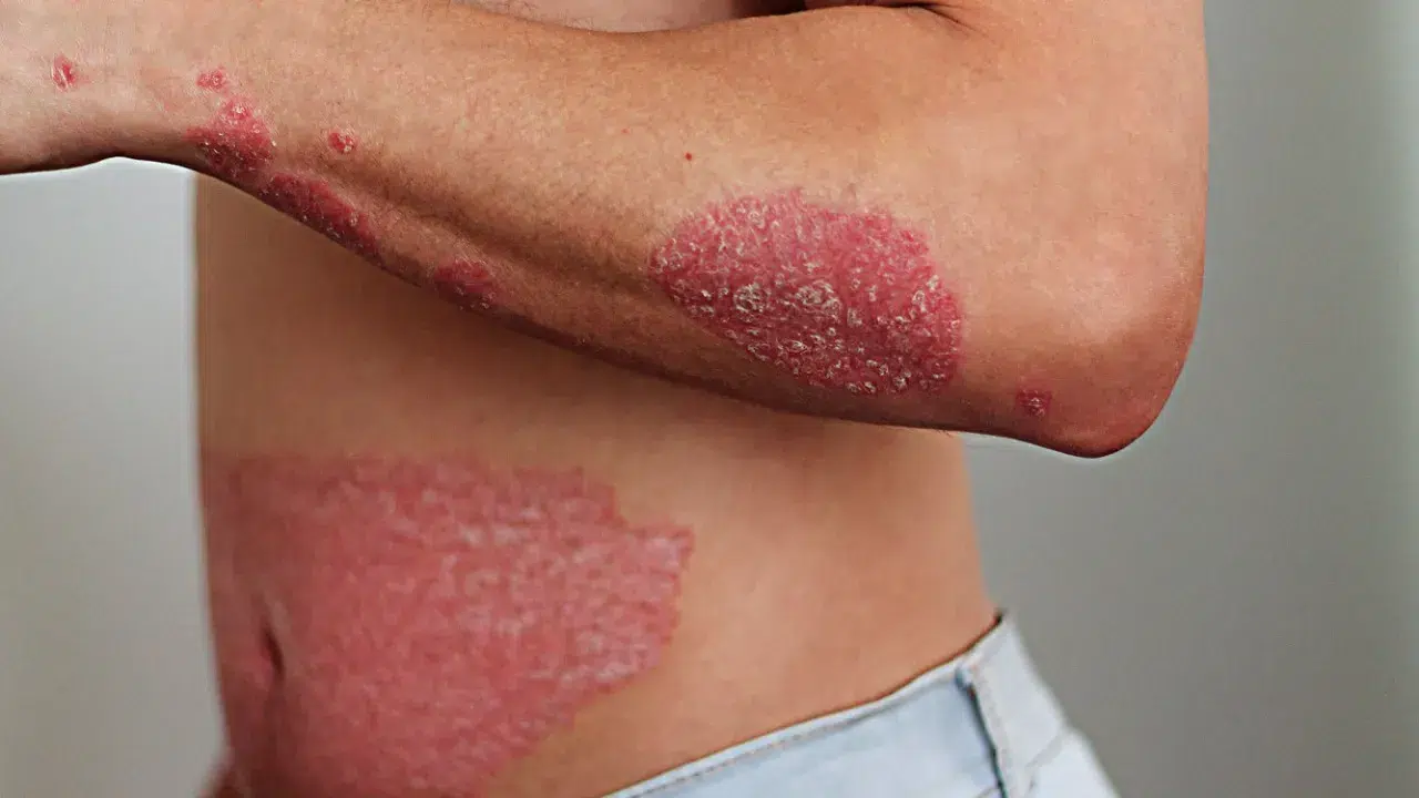 Managing Psoriasis Flares During Rapid Weight Loss: Tips and Strategies